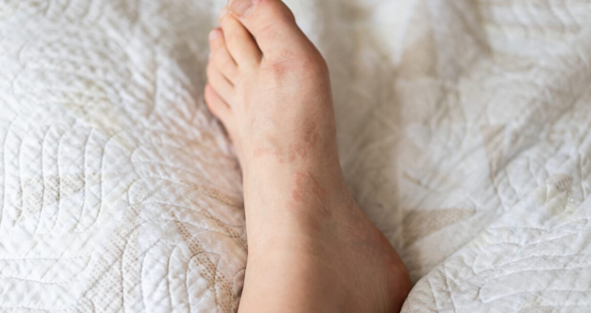 Granuloma annulare is a benign, chronic