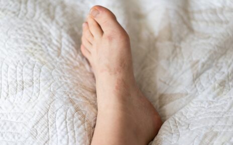 Granuloma annulare is a benign, chronic