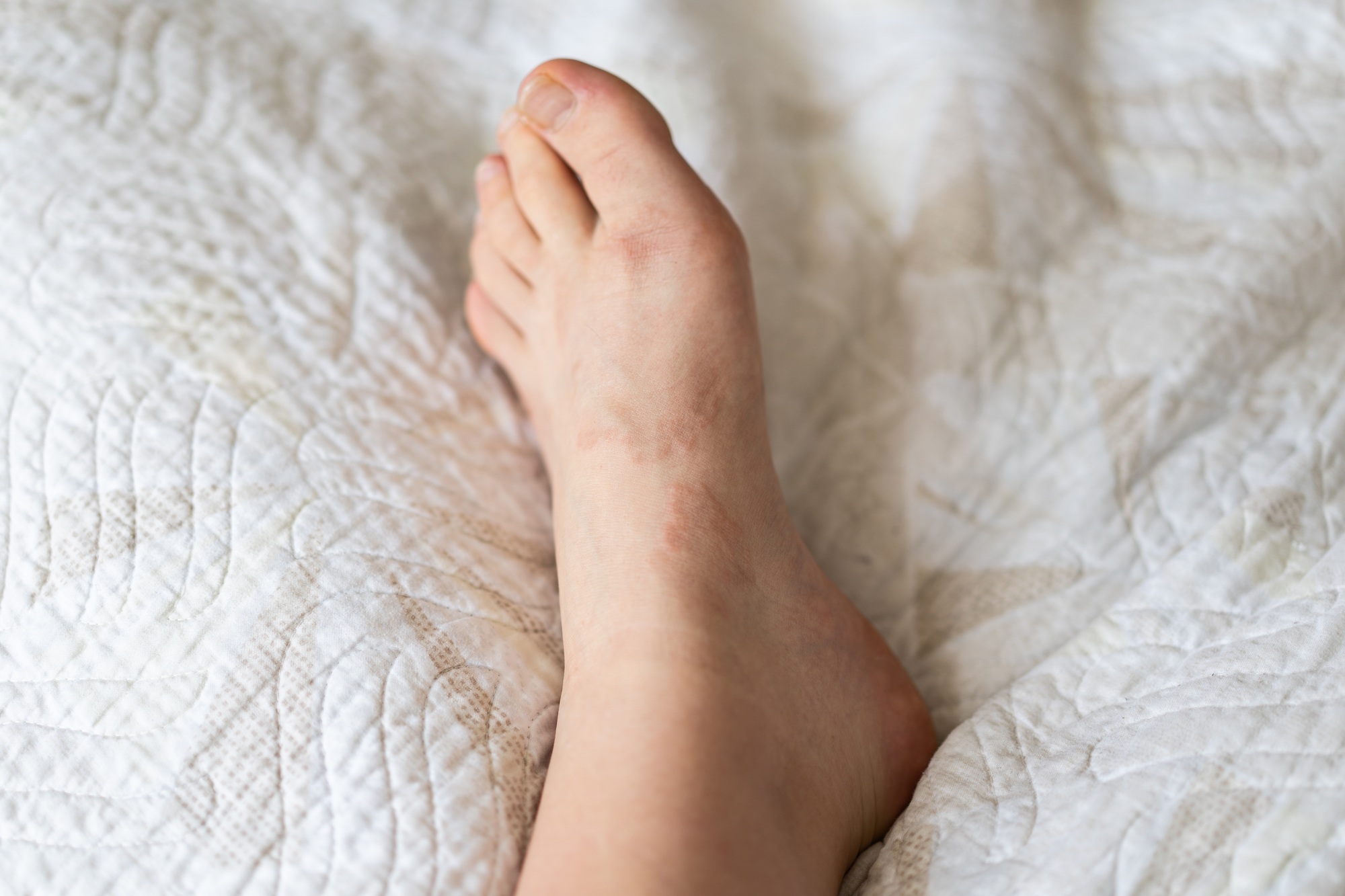 Granuloma annulare is a benign, chronic