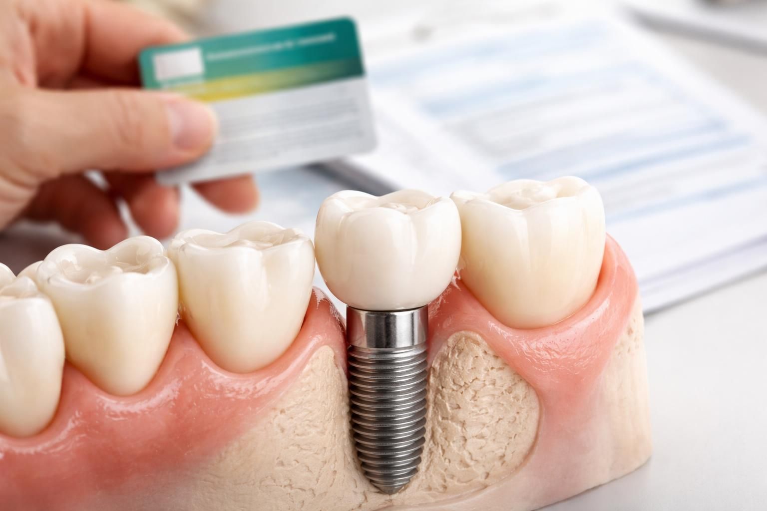 découvrez comment l'assurance maladie et les mutuelles prennent en charge les remboursements pour un implant dentaire, afin de mieux comprendre vos droits et faciliter vos démarches.